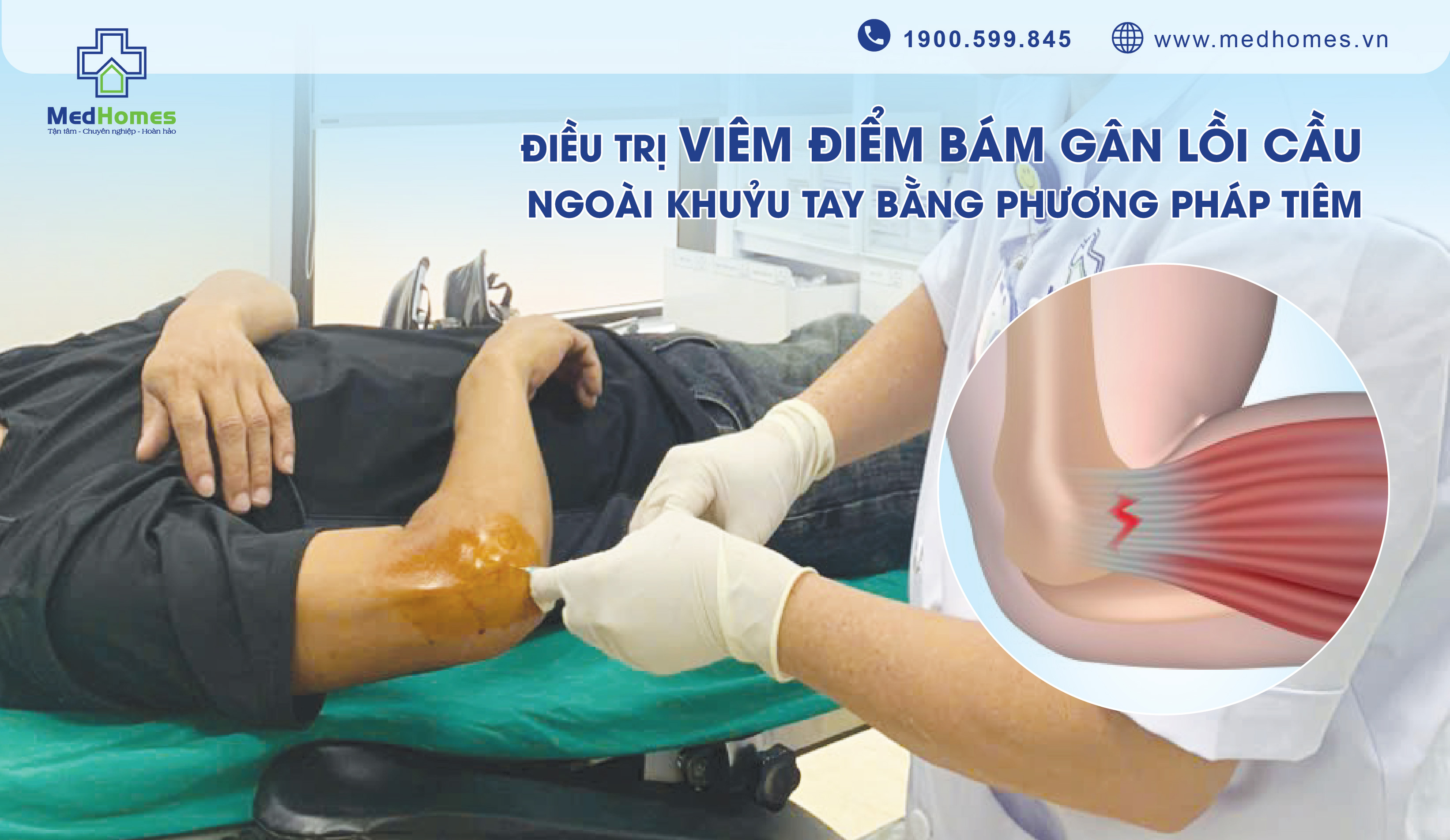 Điều trị viêm điểm bám gân lồi cầu ngoài khuỷu tay bằng phương pháp tiêm