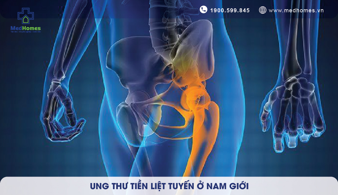 UNG THƯ TIỀN LIỆT TUYẾN Ở NAM GIỚI