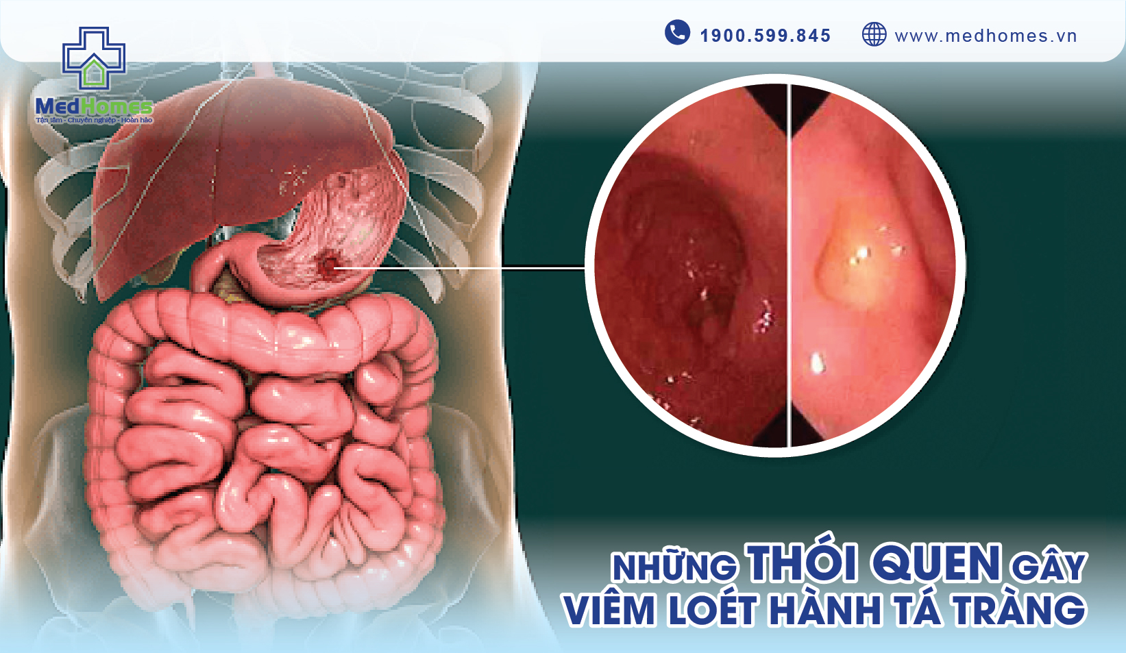 Những Thói Quen Gây Viêm Loét Hành Tá Tràng - Hiểu Để Phòng Tránh