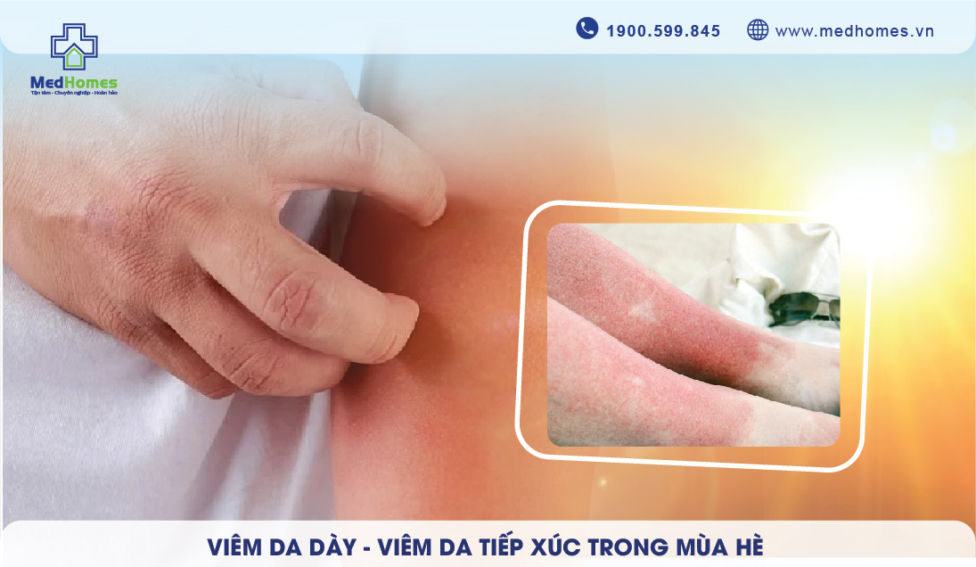 Viêm Da Dày Trong Mùa Hè: Nguyên Nhân, Triệu Chứng và Cách Điều Trị