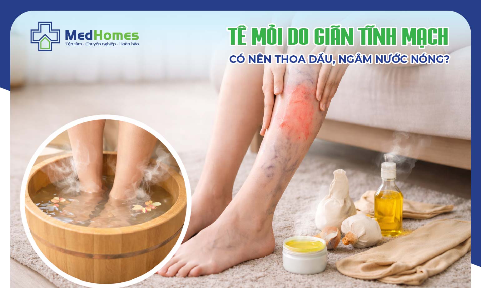 TÊ MỎI DO GIÃN TĨNH MẠCH – CÓ NÊN THOA DẦU, NGÂM NƯỚC NÓNG?