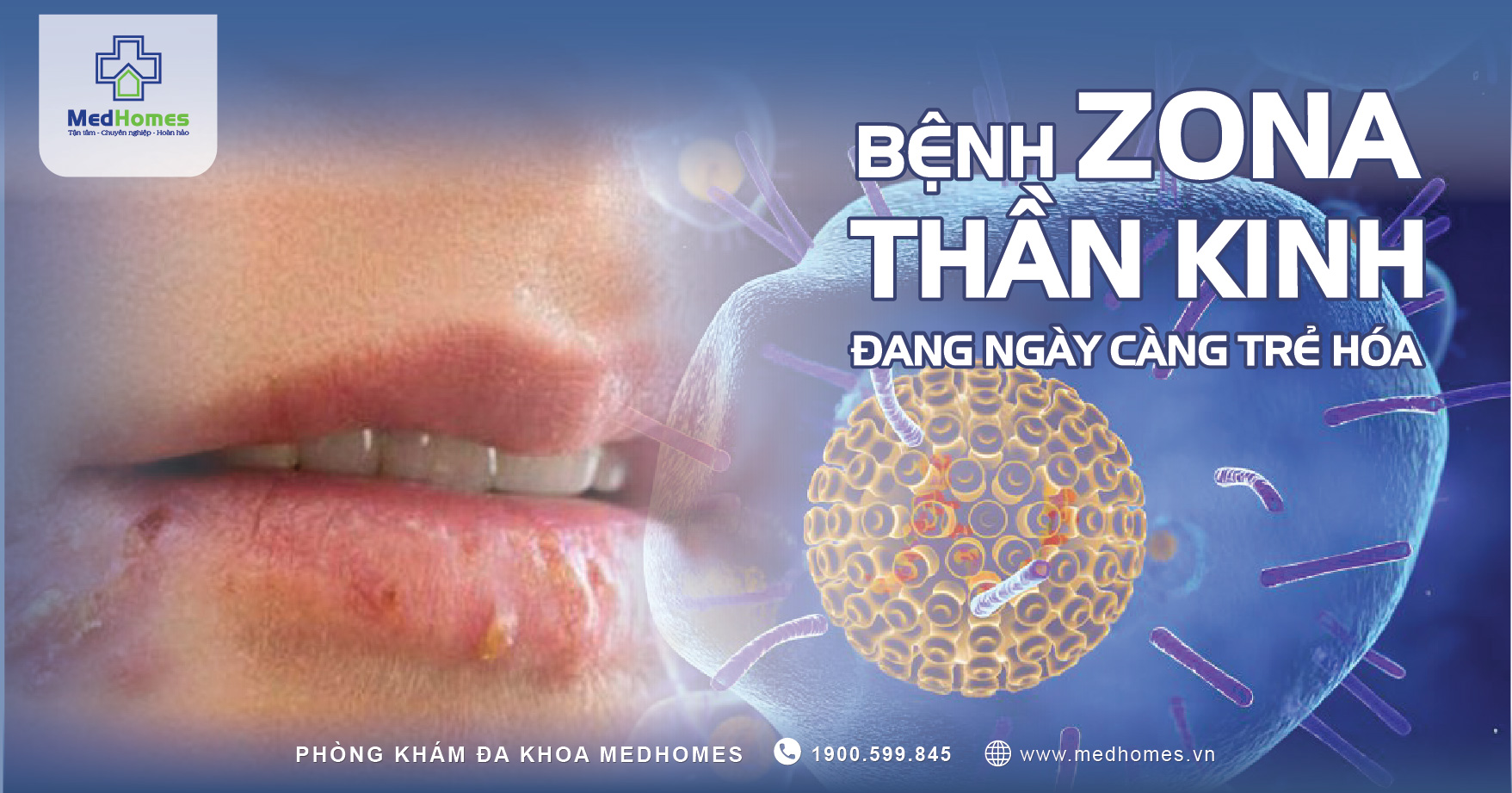 Bệnh Zona Thần Kinh Đang Ngày Càng Trẻ Hóa Và Dễ Bị Nhầm Với Tai Biến