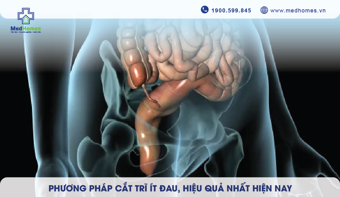 PHƯƠNG PHÁP CẮT TRĨ ÍT ĐAU, HIỆU QUẢ NHẤT HIỆN NAY