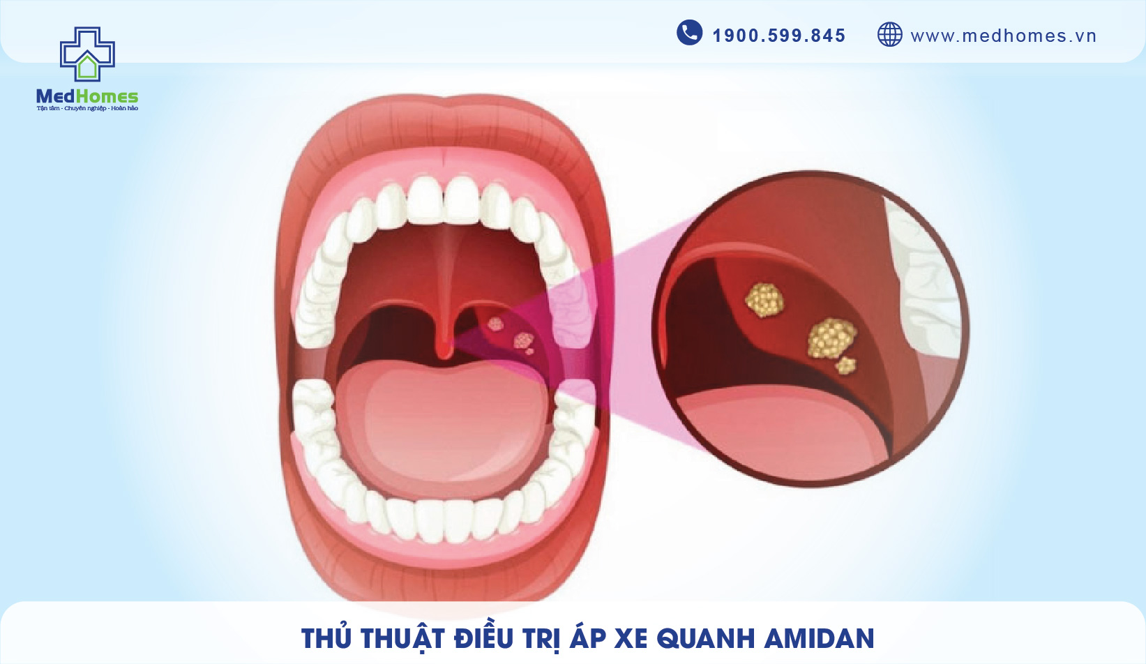 Thủ Thuật Điều Trị Áp Xe Amidan