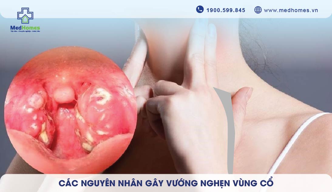 CÁC NGUYÊN NHÂN GÂY VƯỚNG NGHẸN VÙNG CỔ