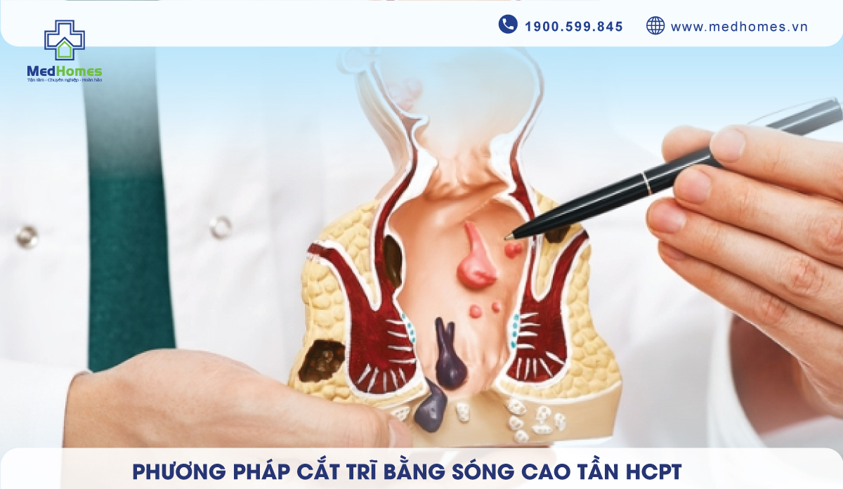 Phương Pháp Cắt Trĩ Bằng Sóng Cao Tần HCPT