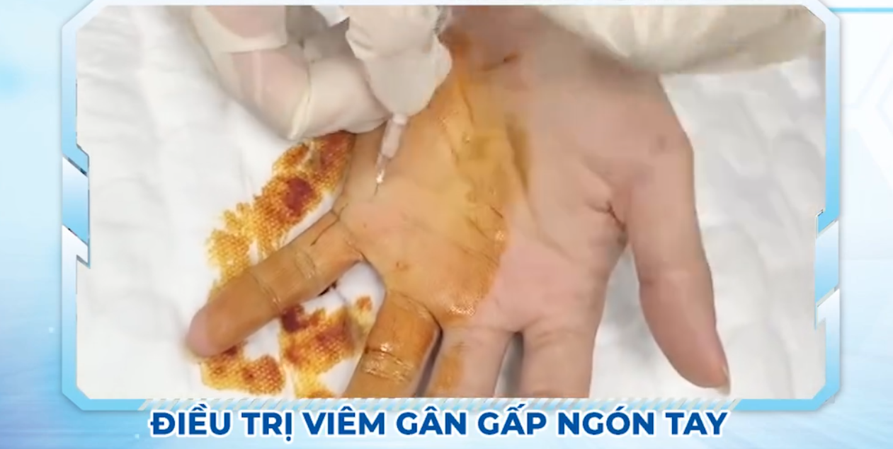 Điều Trị Viêm Gân Gấp Ngón Tay Bằng Phương Pháp Tiêm