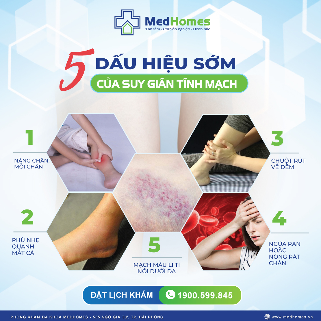  TOP 5 DẤU HIỆU SỚM CỦA SUY GIÃN TĨNH MẠCH BẠN DỄ BỎ QUA