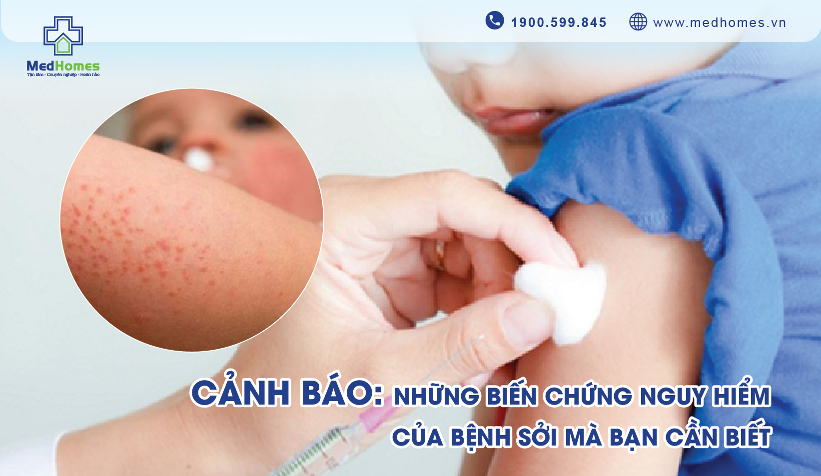 Những Biến Chứng Nguy Hiểm Của Bệnh Sởi Và Cách Phòng Ngừa