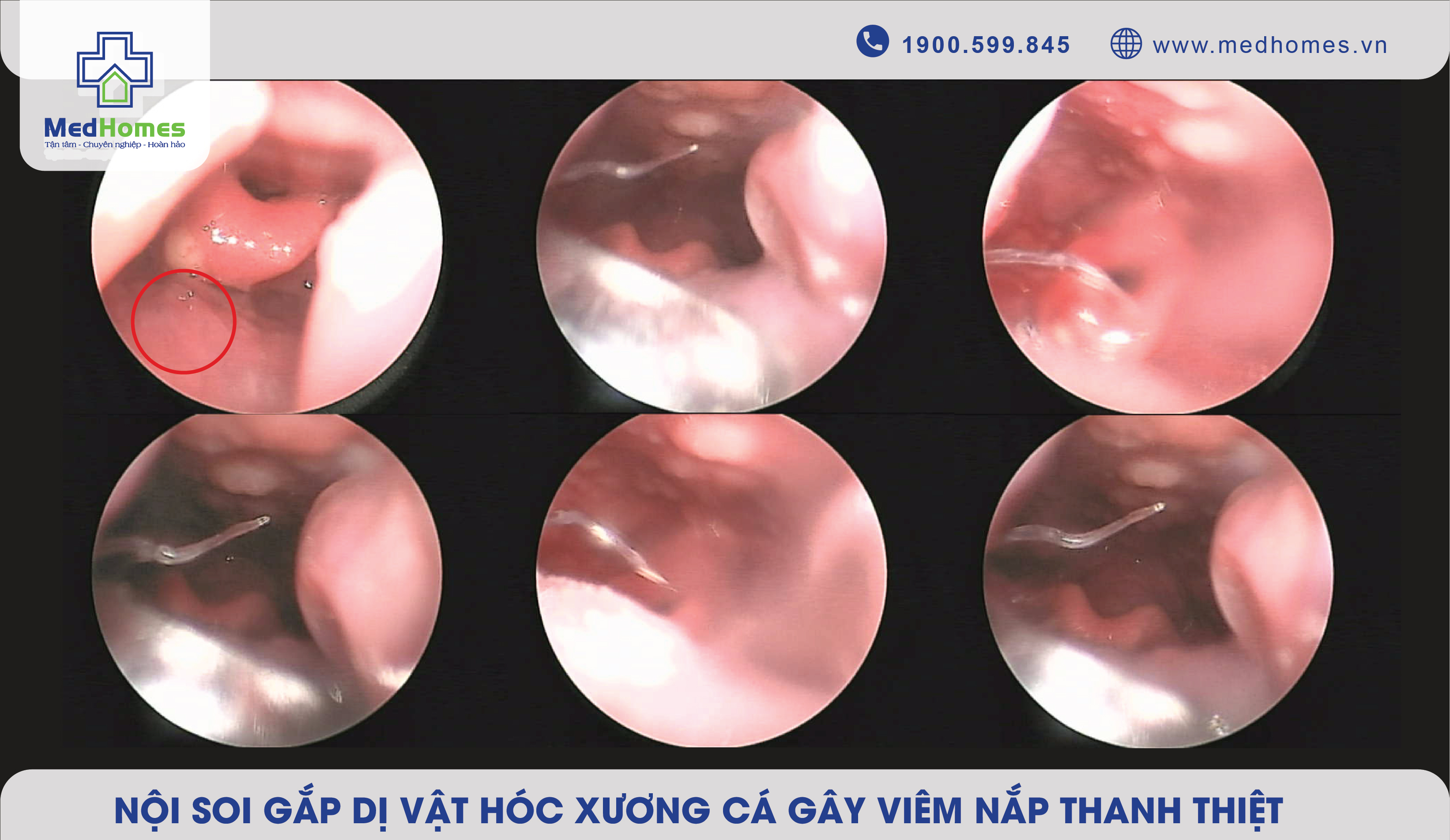 Nội Soi Gắp Dị Vật Hóc Xương Cá Gây Viêm Nắp Thanh Thiệt Tại Phòng Khám Đa Khoa MedHomes