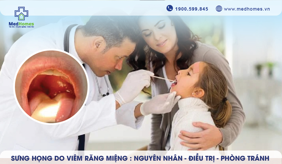 Sưng Họng do viêm răng miệng: Nguyên Nhân, Điều Trị và Phòng Ngừa 