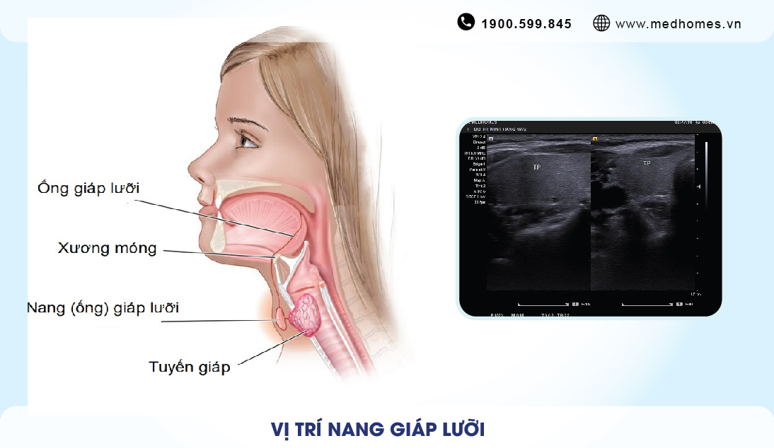Điều trị nang ống giáp lưỡi tại PKĐK MEDHOMES