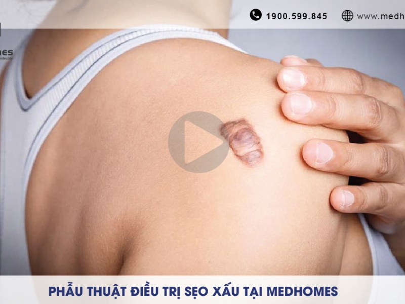 PHẪU THUẬT ĐIỀU TRỊ SẸO XẤU